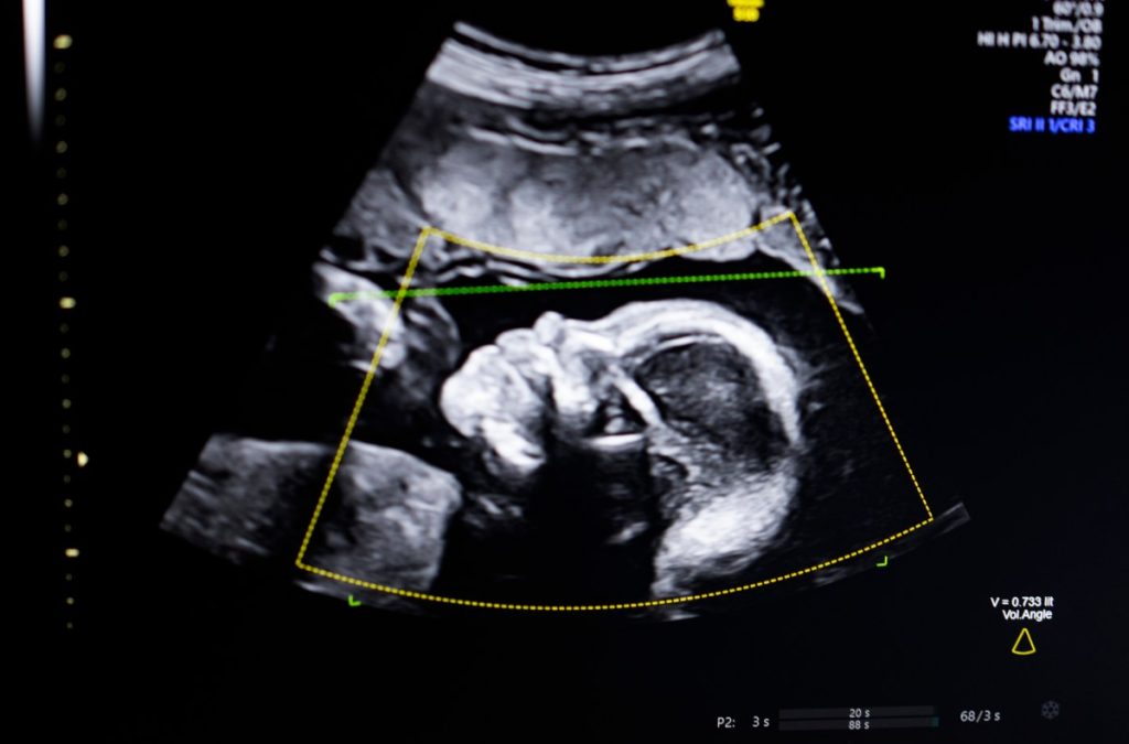 Biotics AI, Battlefield 2023, gains FDA approval for its AI-powered fetal ultrasound product Biotics AI, Battlefield 2023, gains FDA approval for its AI-powered fetal ultrasound product