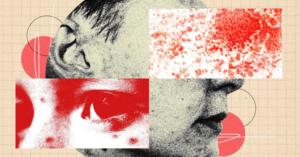 You Should Be More Freaked Out by Shingles You Should Be More Freaked Out by Shingles